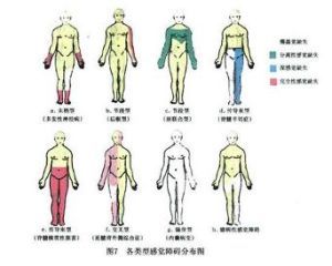 深感覺障礙 深感覺障礙