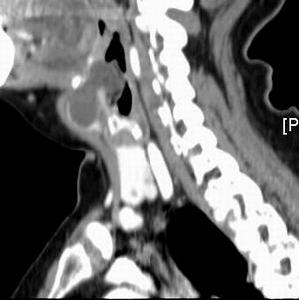 甲狀舌囊腫及瘺管