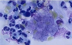 瀰漫性食管痙攣