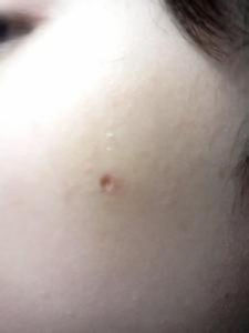 點痣[美容方法]