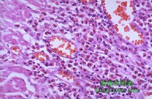 免疫缺陷性肺炎