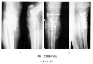 （圖）脛骨平台骨折