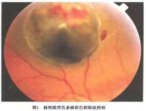 脈絡膜黑色素瘤