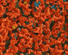 慢性粒細胞白血病