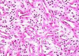 臍窩內有肉芽組織增生 臍窩內有肉芽組織增生