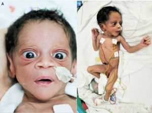 小兒甲狀腺功能亢進症 小兒甲狀腺功能亢進症