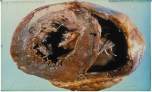 老年人心臟澱粉樣變性 老年人心臟澱粉樣變性