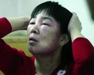 面部浮腫 面部浮腫