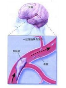 短暫性腦缺血發作