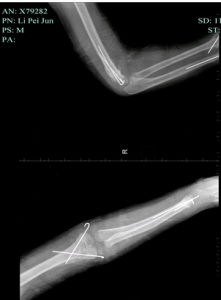 肱骨髁上骨折 肱骨髁上骨折