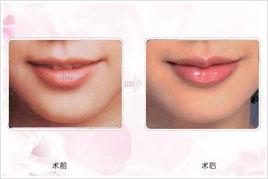 玻尿酸豐唇 玻尿酸豐唇