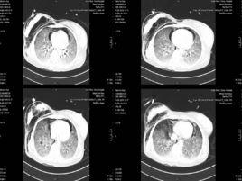 肺部羅音 肺部羅音