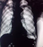 周圍型肺癌 周圍型肺癌