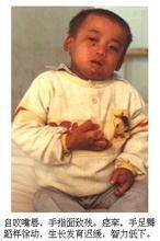 小兒糖原貯積病Ⅱ型 小兒糖原貯積病Ⅱ型