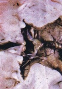 高血壓性腦出血 高血壓性腦出血