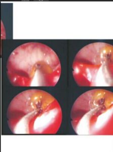 上頜竇炎 上頜竇炎