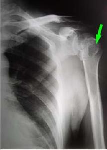 肩關節炎 肩關節炎