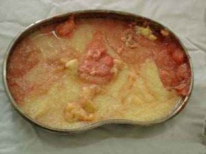 三維剝離術 三維剝離術