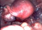 卵巢腫瘤