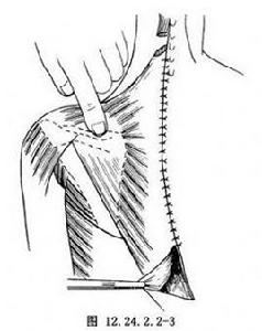 Green肩胛骨下移術 Green肩胛骨下移術