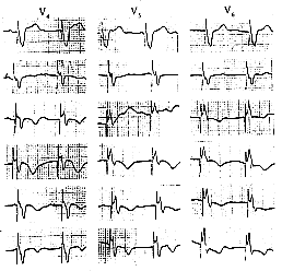 老年急性心肌梗死