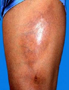 硬皮病治療 硬皮病治療