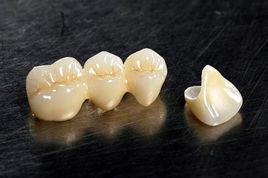 經典三代全瓷冠