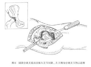 （圖）髖關節結核病