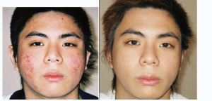 5S綜合祛痘療法 5S綜合祛痘療法