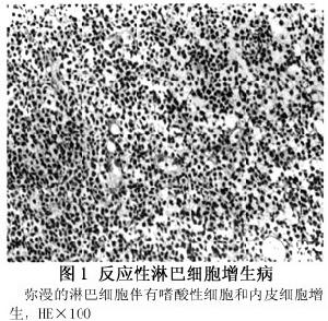 眼眶非霍奇金惡性淋巴瘤
