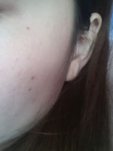 黑色素沉澱 黑色素沉澱