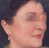 面部皺紋祛除術