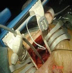 主動脈內囊反搏器 主動脈內囊反搏器