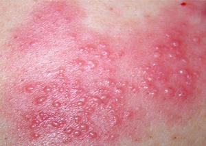 水痘和帶狀皰疹