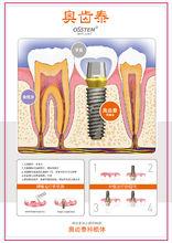 韓國奧齒泰種植系統