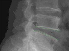 腰椎不穩 腰椎不穩