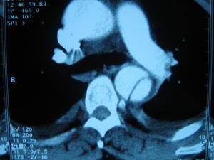 胸主動脈夾層動脈瘤