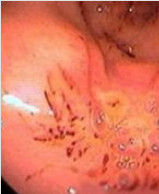 慢性糜爛性胃炎 慢性糜爛性胃炎