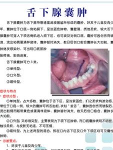 舌下囊腫 舌下囊腫