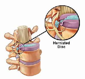 閉合性脊髓損傷