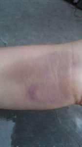 皮下滲血 皮下滲血