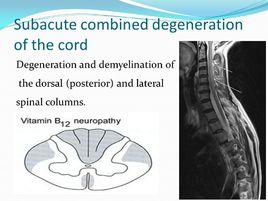 老年人脊髓亞急性聯合變性 老年人脊髓亞急性聯合變性