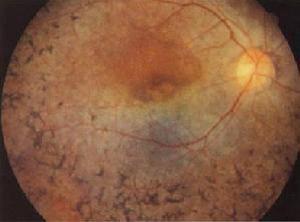 視網膜色素變性