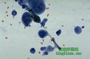 枸櫞酸桿菌肺炎