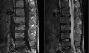 少年性椎體骨軟骨病 少年性椎體骨軟骨病