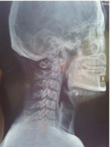 頸椎反弓 頸椎反弓