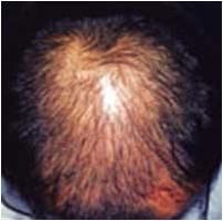 脫髮[疾病]