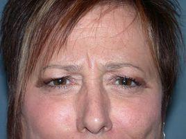 眉間紋去除術 眉間紋去除術