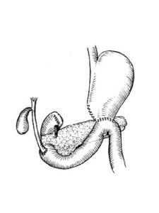 胃空腸吻合術 胃空腸吻合術