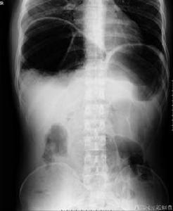 間位結腸 間位結腸